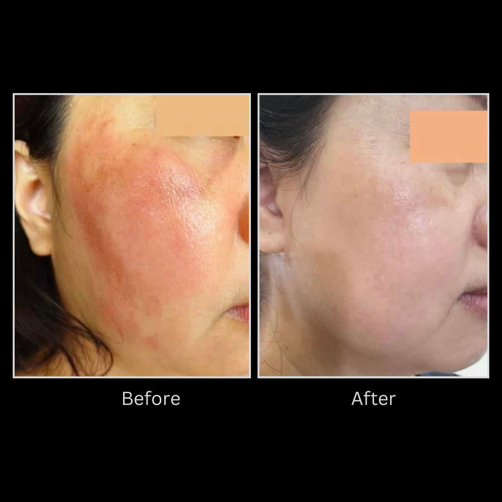 Pigmentation Solutions